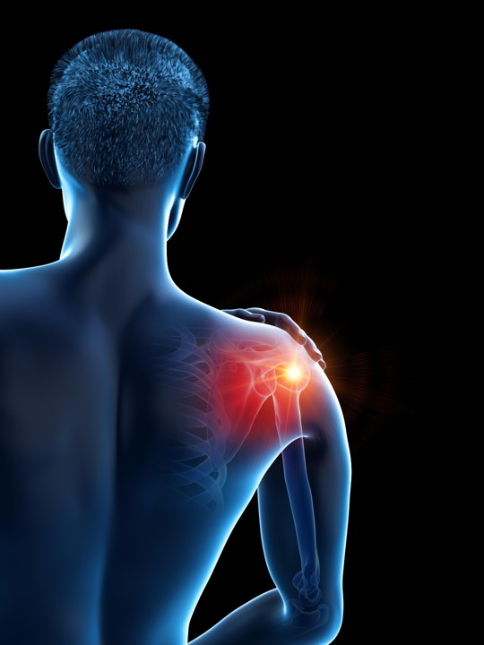 Shoulder Impingement