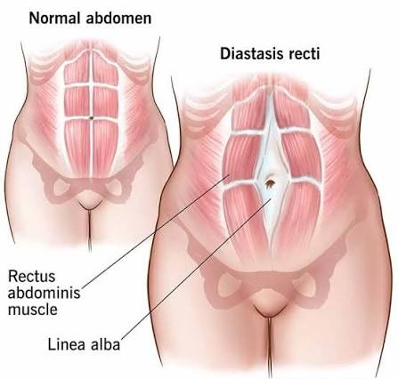 Diastasis Recti