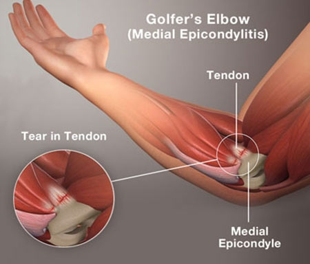 Tennis Elbow / Golfer's Elbow