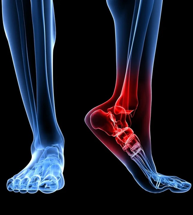 Ankle Sprain & Heel Pain