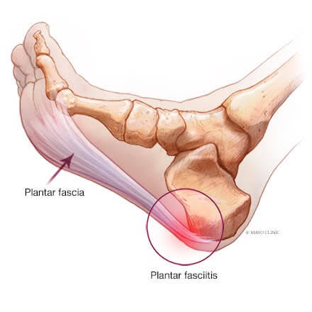 Plantar Fasciitis